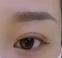 从单眼皮到双眼皮,全切术后的惊艳转变